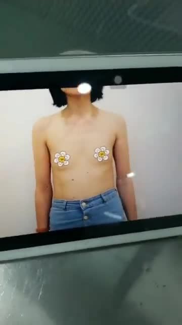Nâng ngực nội soi đã có kết quả ngay sau khi làm nhé cả nhà!