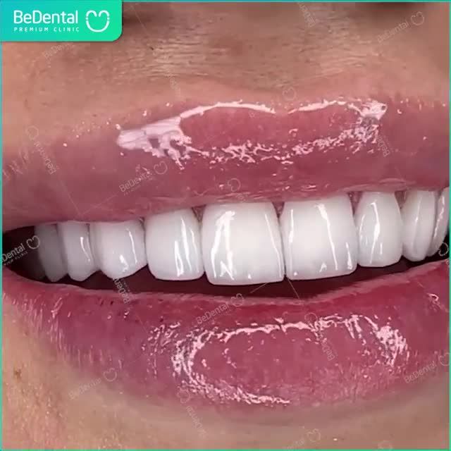 Ngày xưa răng đẹp là do trời cho Ngày nay răng đẹp là do người làm