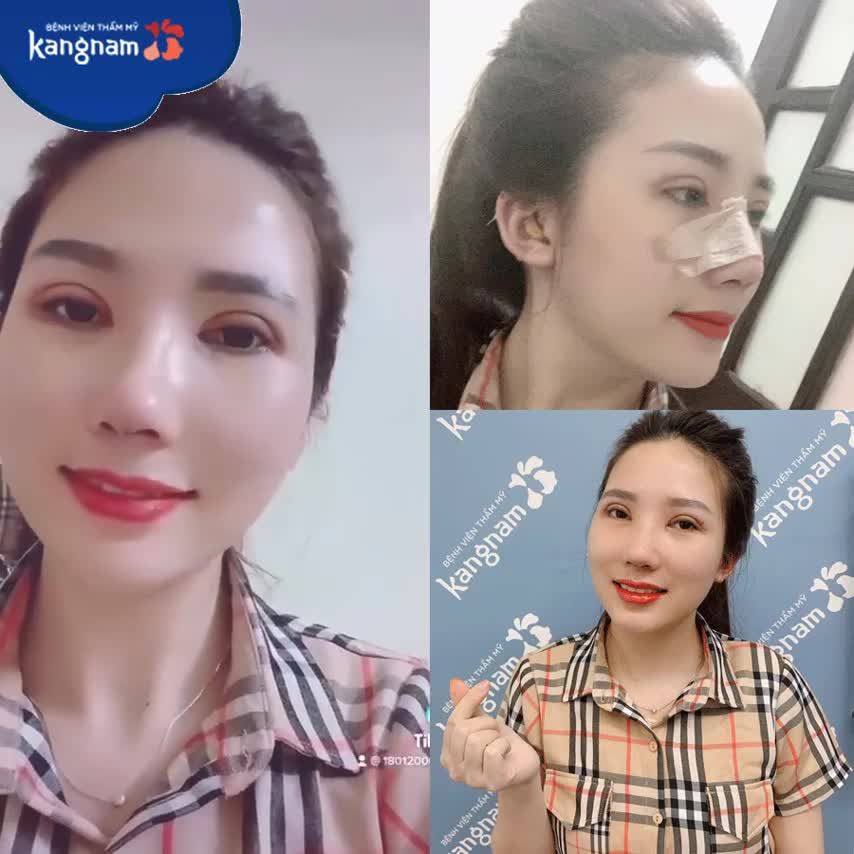 "Nghe nhiều review nâng mũi cắt mí Kangnam đẹp tự nhiên lắm, quyết định làm luôn và đúng là sự lựa chọn KHÔNG SAI!"