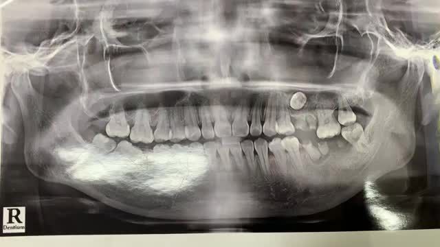 Nhổ răng khôn 48 lệch 45 độ, sâu vào tuỷ gây đau nhức cho chị Hạnh.
