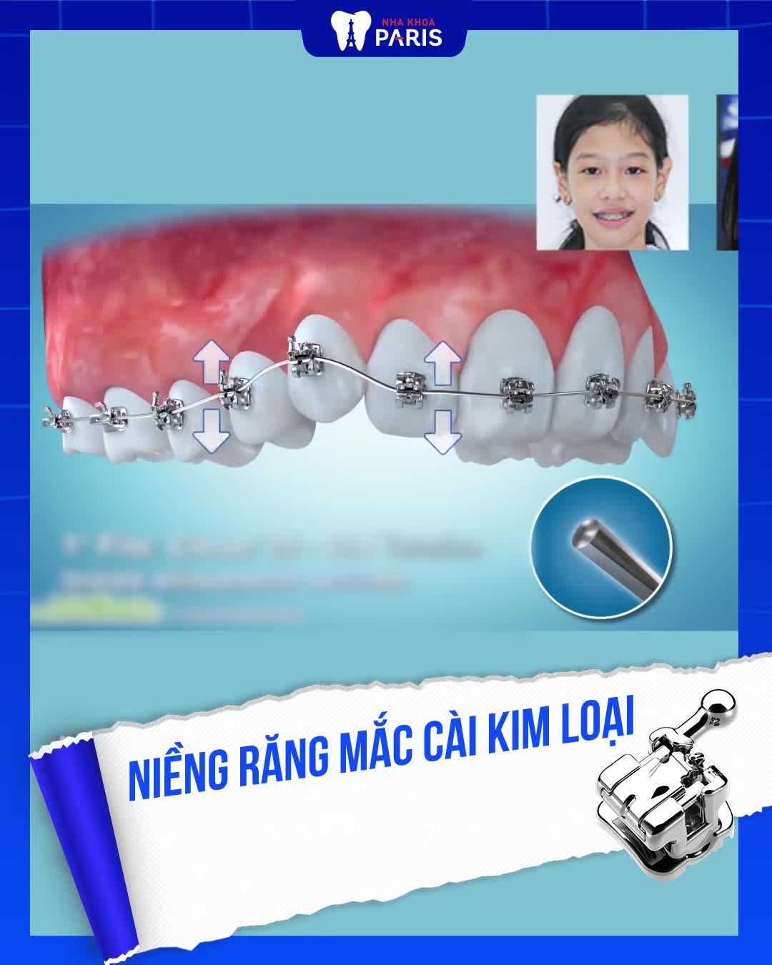 Niềng răng: Chọn TỐC ĐỘ hay THẨM MỸ?