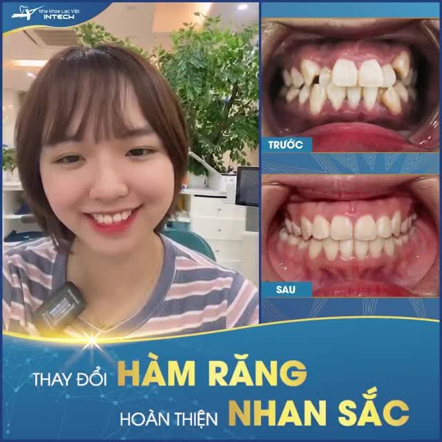 NIỀNG RĂNG - GIẢI PHÁP KHẮC PHỤC TÌNH TRẠNG RĂNG KHẤP KHỂNH