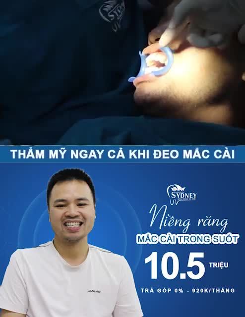 NIỀNG RĂNG HÔ CÓ HẾT CƯỜI HỞ LỢI HAY KHÔNG