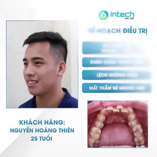 NIỀNG RĂNG MẮC CÀI SỨ CẢI THIỆN RĂNG HÔ- HOTBOY QUÂN ĐỘI TỰ TIN KHOE NỤ CƯỜI MỚI