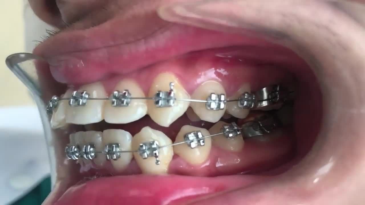 NIỀNG RĂNG - QUẢ NGỌT XỨNG ĐÁNG CHO SỰ KIÊN TRÌ