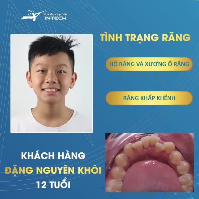 NIỀNG RĂNG TRẺ EM - CAN THIỆP SỚM, HIỆU QUẢ CAO