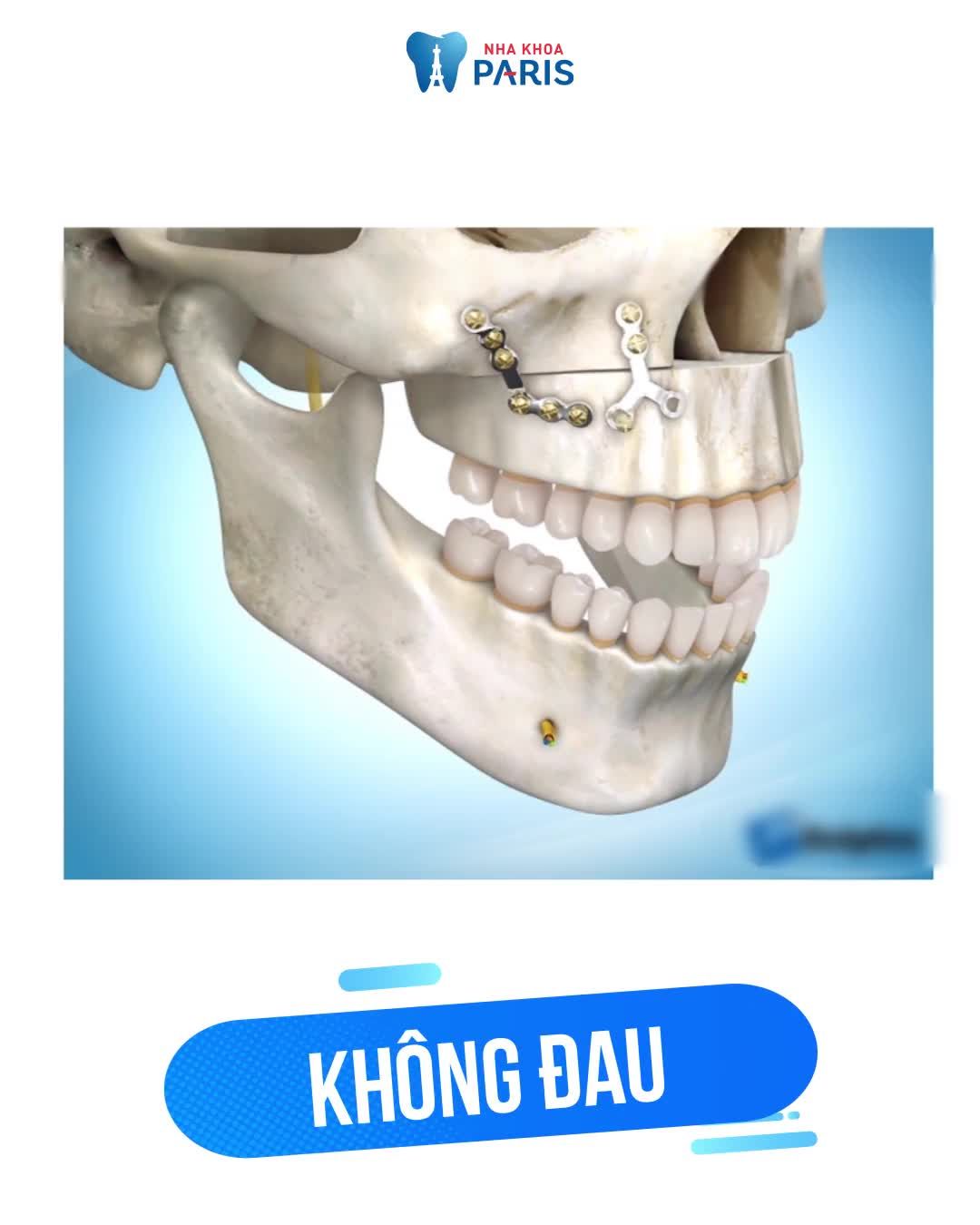 PHẪU THUẬT HÀM - BIẾT TRƯỚC KẾT QUẢ