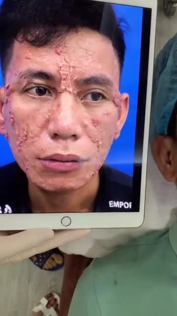 Quá trình điêu trị sẹo lồi cho khách hàng với tình trạng Phức tạp