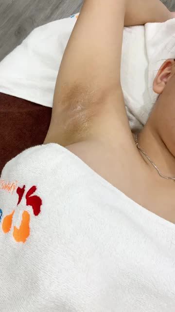 Quá trình triệt lông nách vĩnh viễn với công nghệ Diode Laser của BVTM KANGNAM