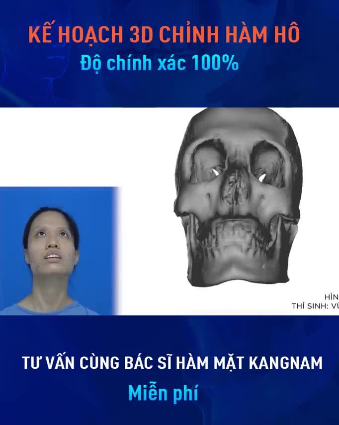 Quét 360 độ cấu trúc hàm sọ với phần mềm thiết kế hàm mặt 3D