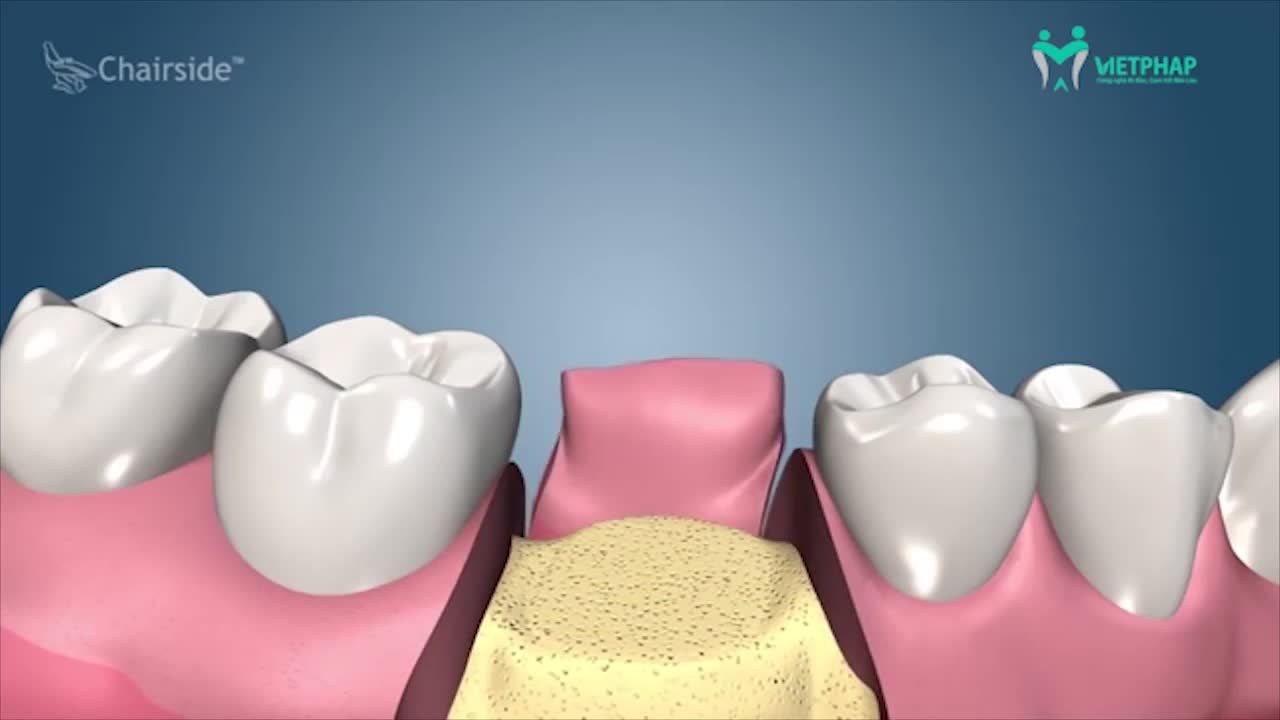 QUY TRÌNH CẤY GHÉP IMPLANT ĐƯỢC THỰC HIỆN NHƯ THẾ NÀO?