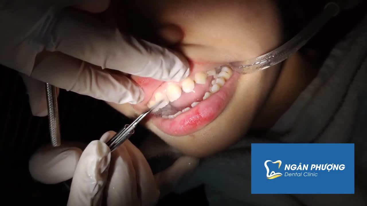 QUY TRÌNH GẮN MẮC CÀI NIỀNG RĂNG