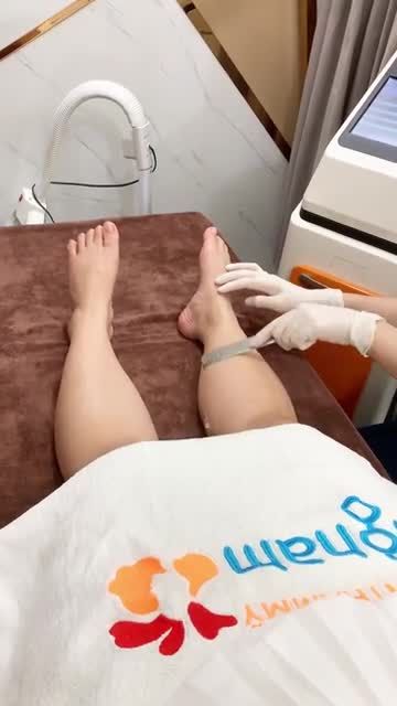 Quy trình triệt lông chân bằng công nghệ Diode laser tại BVTM KANGNAM