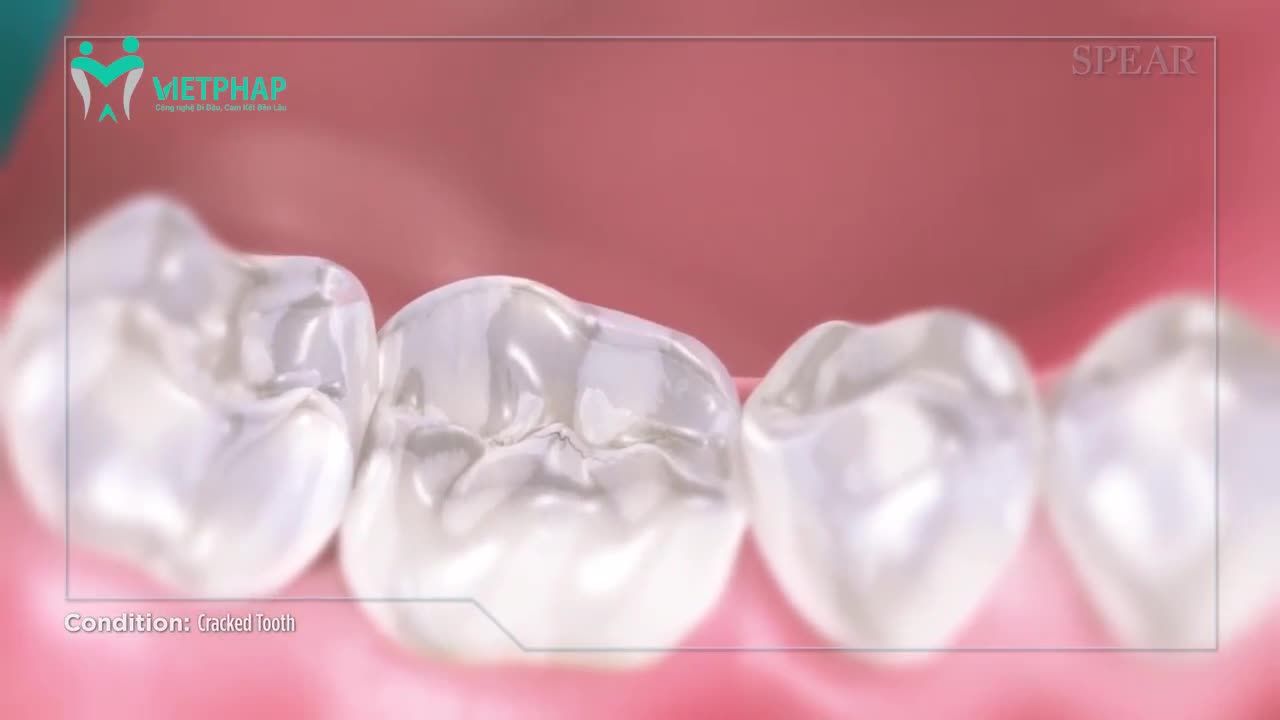 RĂNG HÀM BỊ VỠ CÓ NGUY HIỂM KHÔNG