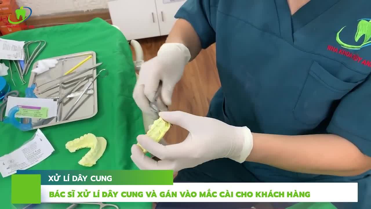 RĂNG MÓM, LỆCH LẠC KÈM THEO LỆCH MẶT NÊN CẢI THIỆN BẰNG PHƯƠNG PHÁP NÀO