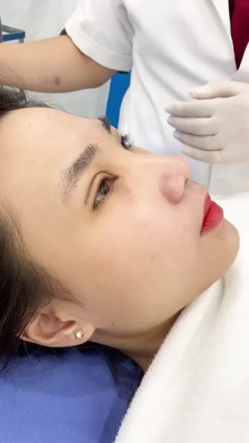 Sau 5 NGÀY cắt mí - Mắt nhìn như thế nào?