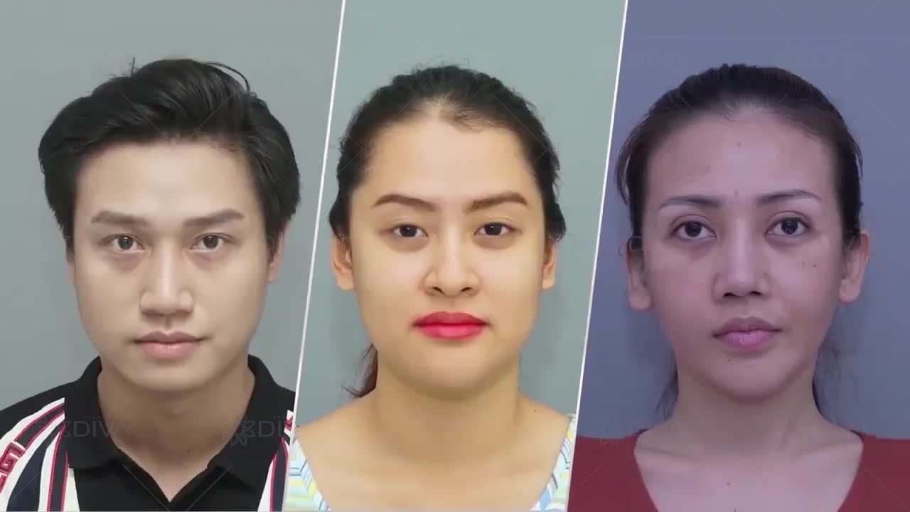 SAU TÁCH TÚI MỠ MÁ TRONG GƯƠNG MẶT THAY ĐỔI RA SAO ?