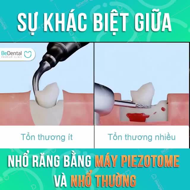 SỰ KHÁC BIỆT GIỮA NHỔ RĂNG PIEZOTOME VÀ NHỔ RĂNG THƯỜNG