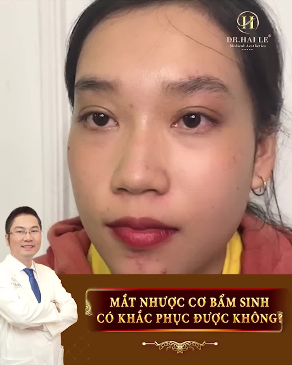 Sụp mí bẩm sinh có chữa được không?