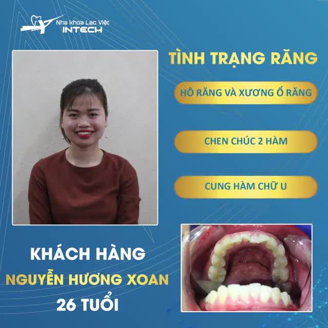 TẠM BIỆT HÀM RĂNG HÔ BẰNG PHƯƠNG PHÁP NIỀNG RĂNG MẮC CÀI KIM LOẠI