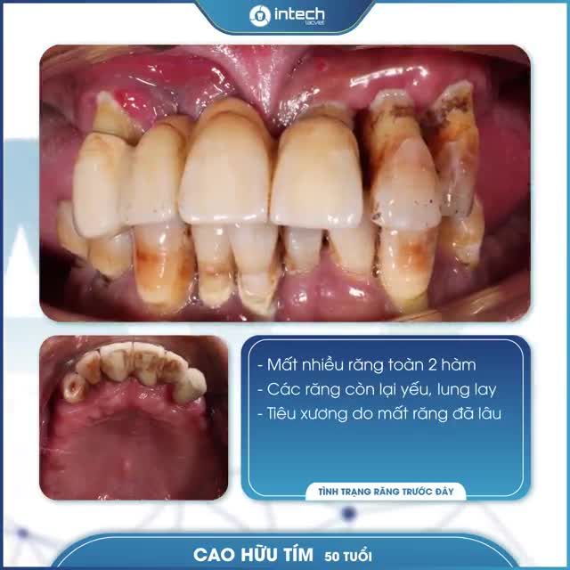 THÀNH QUẢ TRỒNG RĂNG IMPLANT TOÀN HÀM THÀNH CÔNG TẠI NHA KHOA LẠC VIỆT INTECH