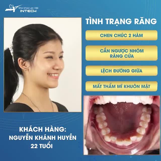 THÁO NIỀNG CHỈ SAU 1 NĂM NIỀNG RĂNG CHEN CHÚC TẠI NHA KHOA LẠC VIỆT INTECH