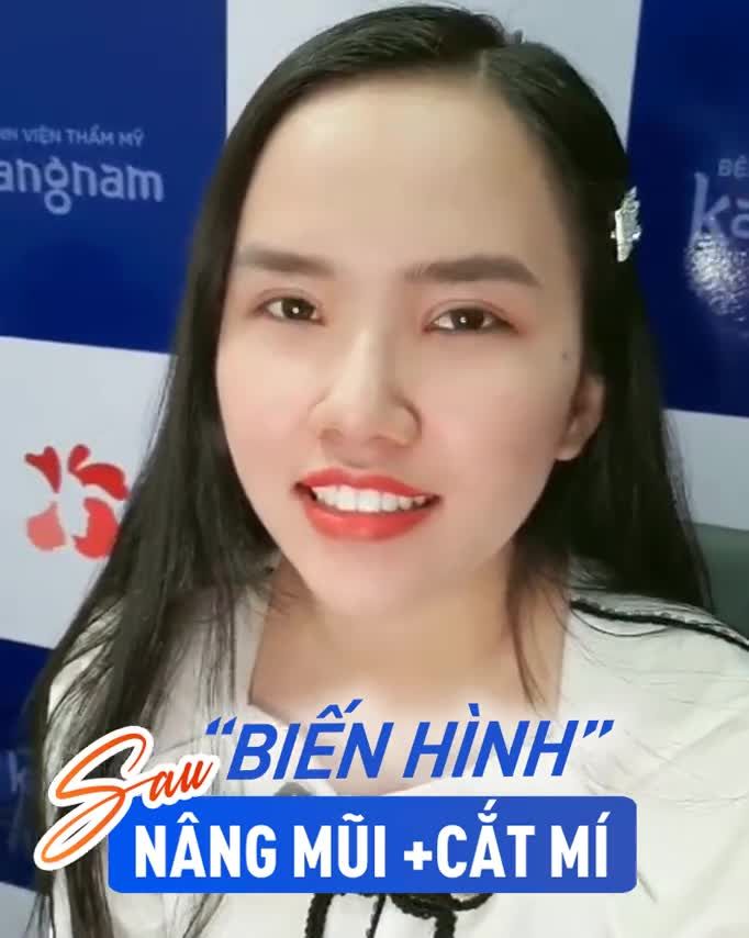 Thay đổi 360 độ với combo Nâng mũi + Cắt mí Đẹp tự nhiên Gương mặt hài hòa  Không lộ dấu tích thẩm mỹ