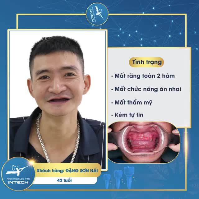 THAY ĐỔI DIỆN MẠO BẤT NGỜ VỚI TRỒNG RĂNG IMPLANT TOÀN HÀM ALL-ON-4