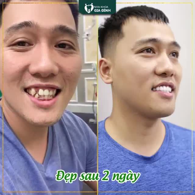 THAY ĐỔI NGOẠN MỤC NHỜ THẨM MỸ RĂNG SỨ TẠI NHA KHOA GIA ĐÌNH