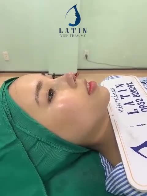 Thêm một ca mũi cấu trúc form nhẹ nhàng tự nhiên nhà Latin để khách hàng tham khảo.