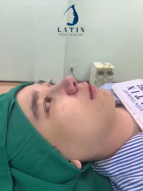 Tiếp tục 1 ca mũi cho bạn nam, thực hiện nâng mũi nâng mũi bán cấu trúc, thu nền xương, chỉnh gồ, cuốn cánh mũi.