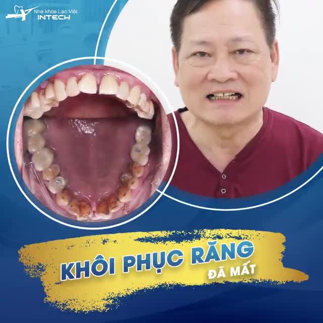 TRỒNG RĂNG IMPLANT GIÚP KHÁCH HÀNG ĂN NHAI MỌI THỨ NGON NHẤT TRÊN ĐỜI - MỘT CA TRỒNG IMPLANT RĂNG HÀM TIÊU BIỂU TẠI NHA KHOA LẠC VIỆT INTECH