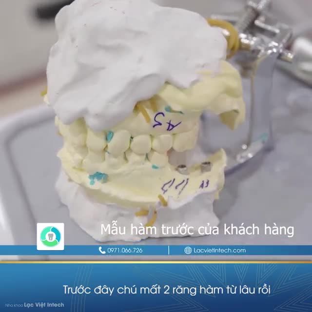 TỪ BỎ CẦU RĂNG SỨ, TRỒNG RĂNG IMPLANT ĂN NHAI BỀN VỮNG