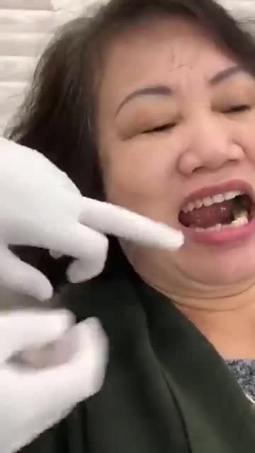 TỤT LỢI, MÒN CỔ RĂNG nên xử lý như thế nào?