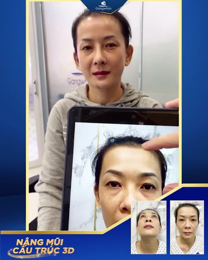 VÌ SAO NHIỀU NGƯỜI THÍCH NÂNG MŨI CẤU TRÚC