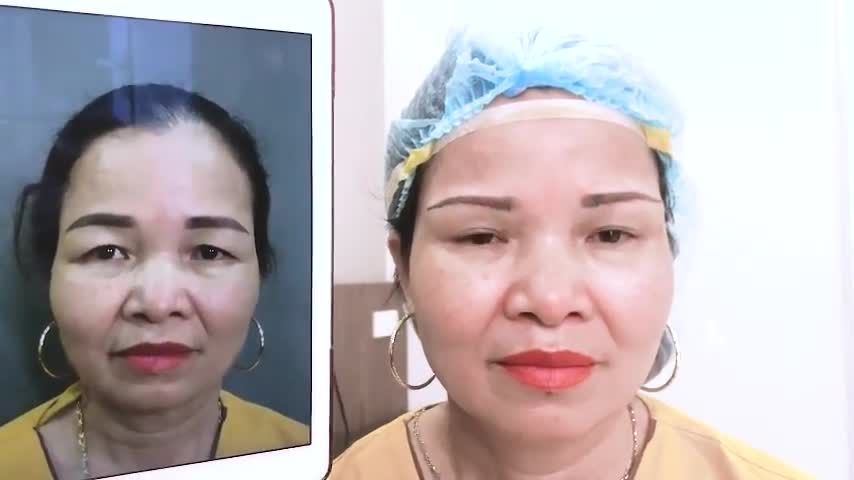 Vì sao tiểu phẫu Nâng cung mày người ta thường gọi một cách ví von là "khắc tinh" của mí sụp tuổi trung niên
