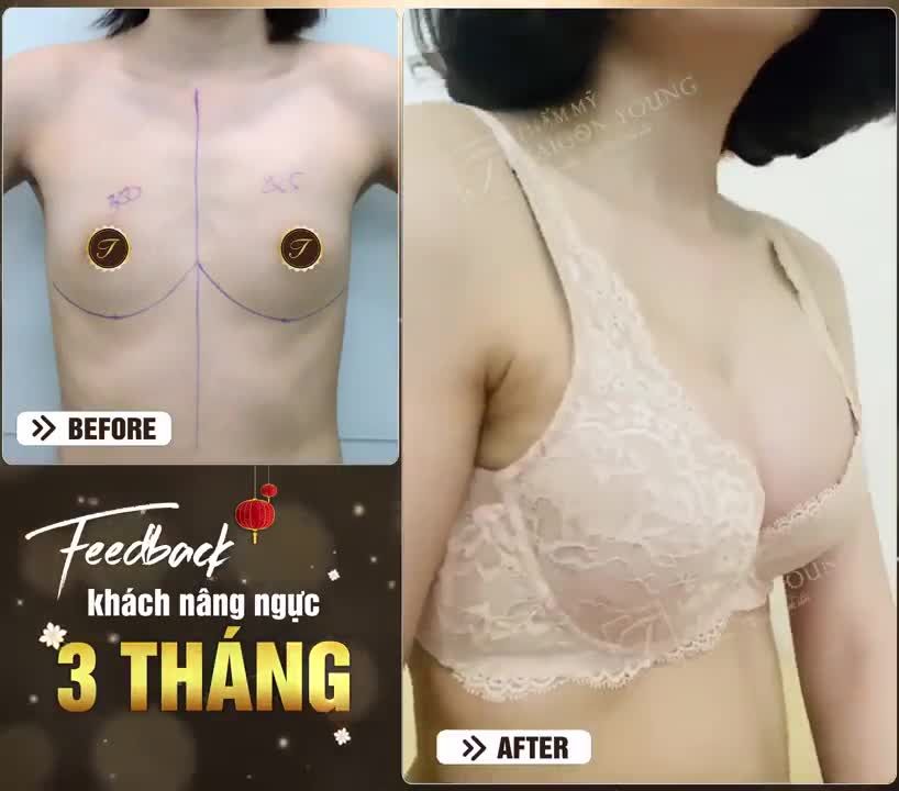 VÒNG 1 SIÊU PHẲNG KHÔNG CÒN LÀ NỖI LO