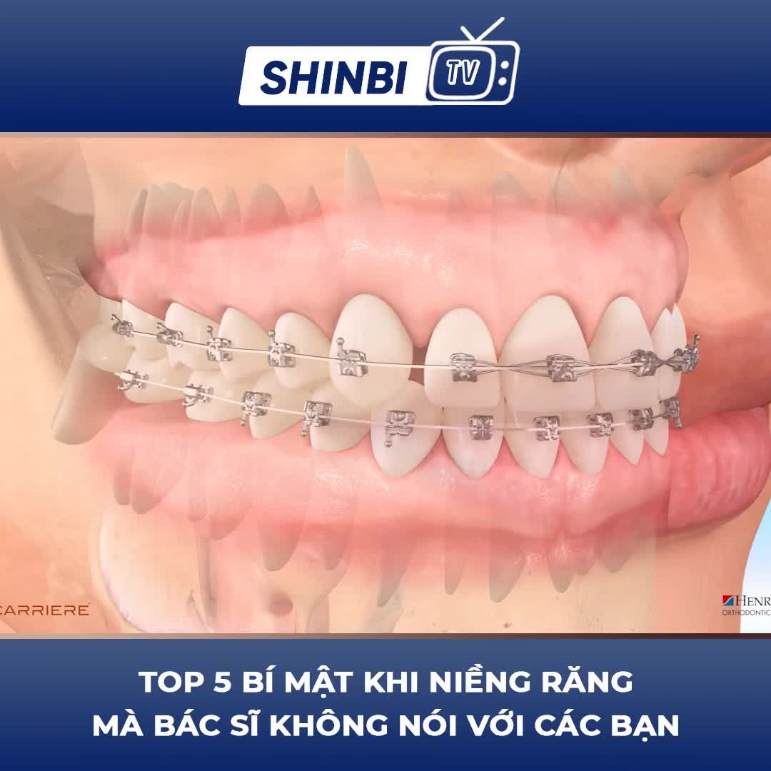 99% NHỮNG NGƯỜI CHƯA NIỀNG RĂNG KHÔNG BIẾT ĐIỀU NÀY