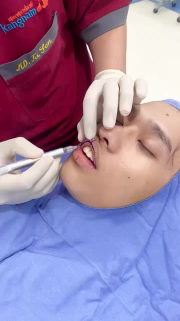 Bác sĩ Kangnam phân tích phẫu thuật thu mỏng môi cho khách hàng nam sở hữu đôi môi dày