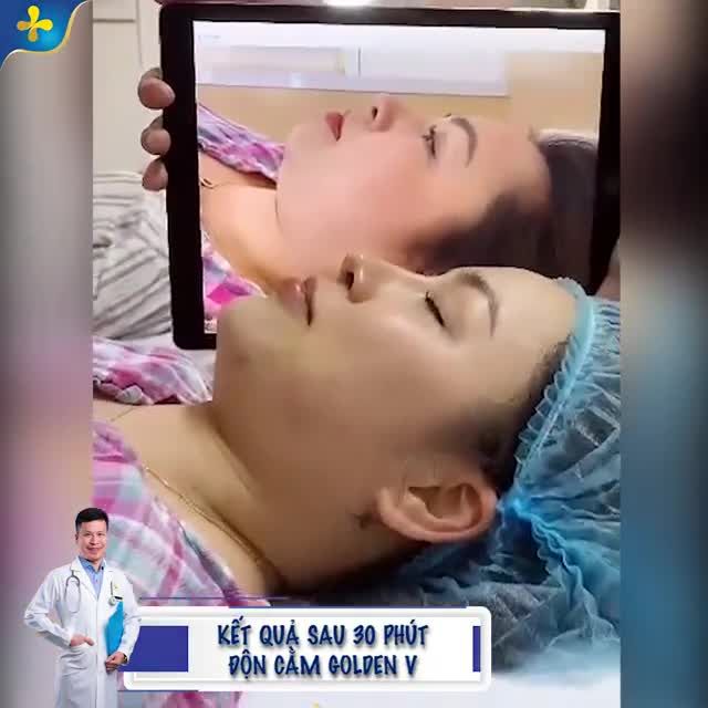 Bẩm sinh cằm ngắn, lẹm phải làm sao ️