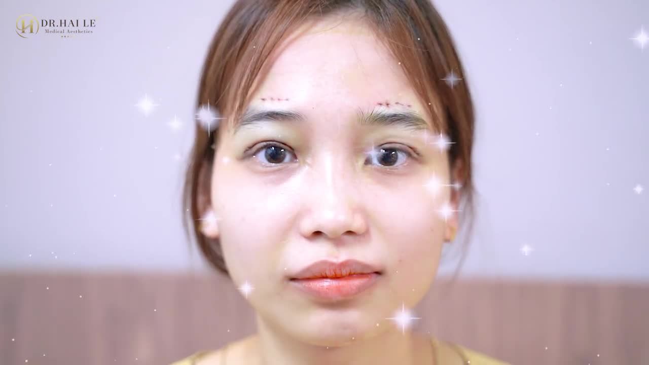 Bạn ấy nói sửa mí xong nhẹ hẳn cả người.