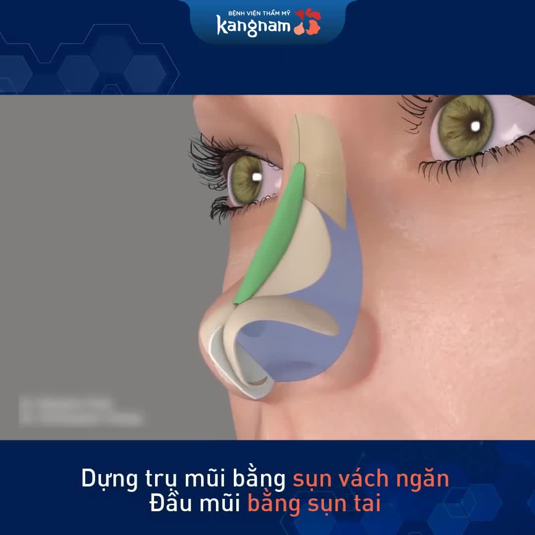 BIẾT đến NÂNG MŨI thì nhiều nhưng HIỂU thì không phải ai cũng rõ!!!