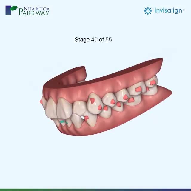 BIẾT TRƯỚC KẾT QUẢ CHỈNH NHA VỚI NIỀNG RĂNG TRONG SUỐT INVISALIGN