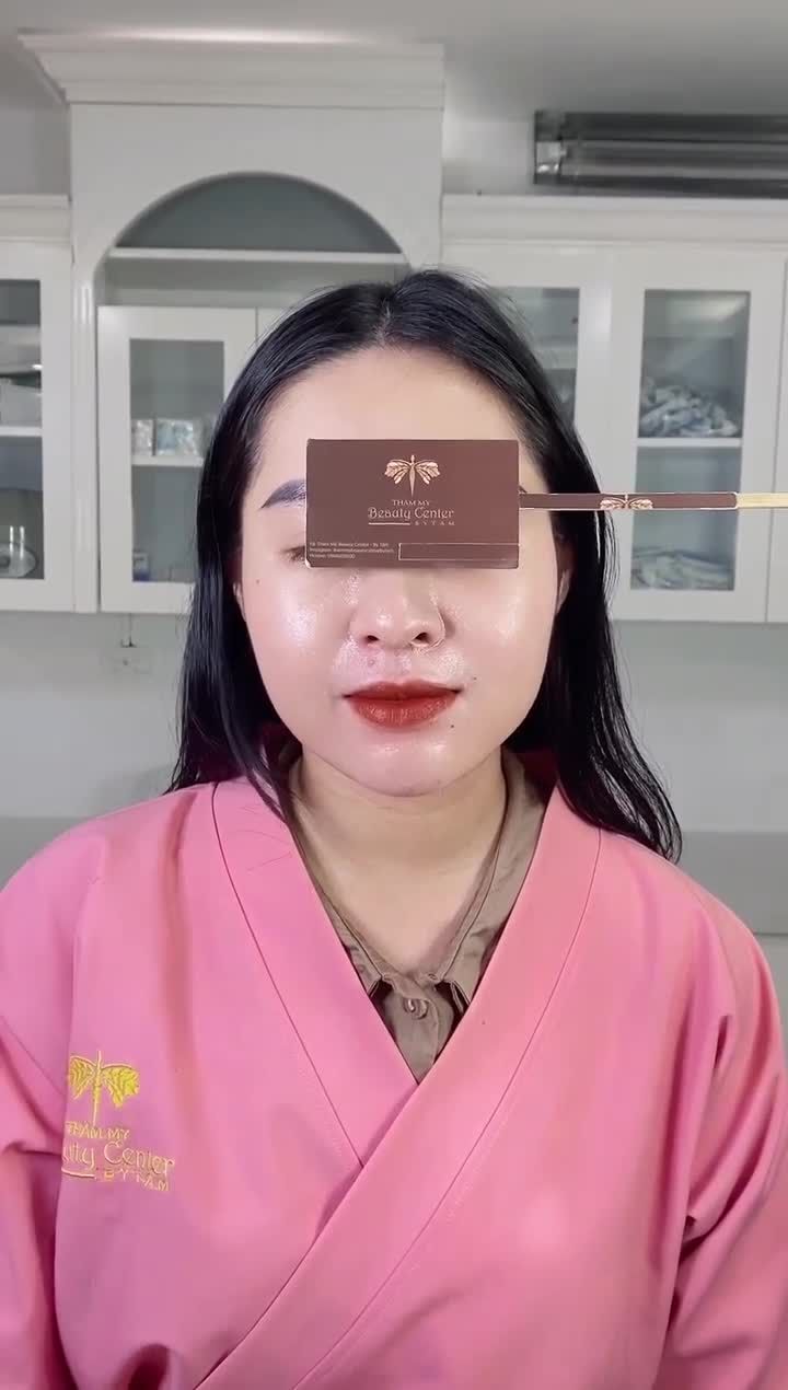 Botox thon gọn hàm giải quyết triệt để tình trạng “mặt to hàm bạnh” cho chị khách hàng.