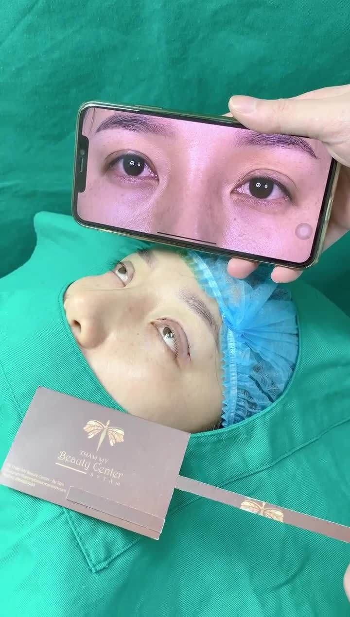 ca Cắt mí Line Mini, cấy mỡ mắt của khách hàng giúp tạo nếp mí to tròn, giải quyết tình trạng gầy hốc hác.