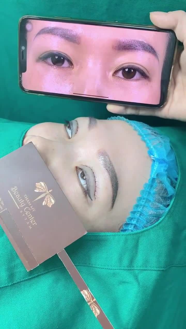 ca cắt mí Line Mini cho khách hàng trung tuổi, mí sụp, da trùng nhiều. Bác sĩ tạo hình 2 mí to tròn đều, cân đối giúp mắt thu hút hơn.