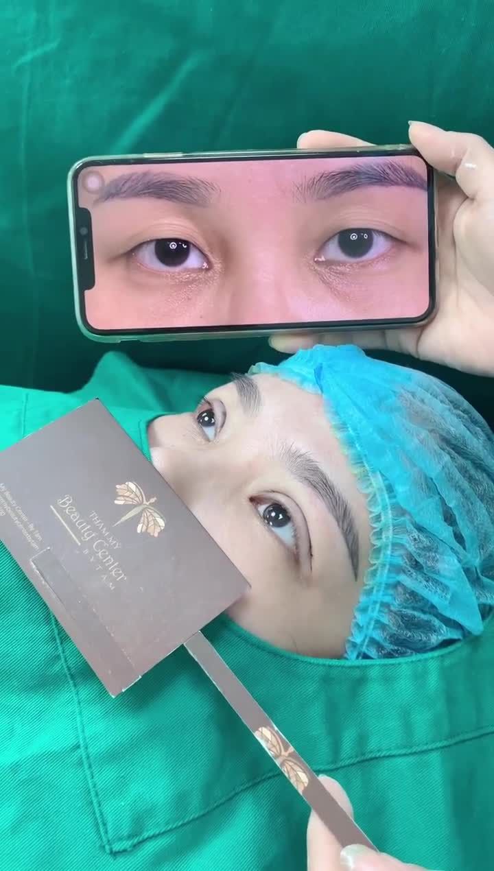 Ca cắt mí Line Mini cuối ngày đẹp xuất sắc tại Tấm. So sánh với hình ảnh trước làm để thấy rõ sự khác biệt.