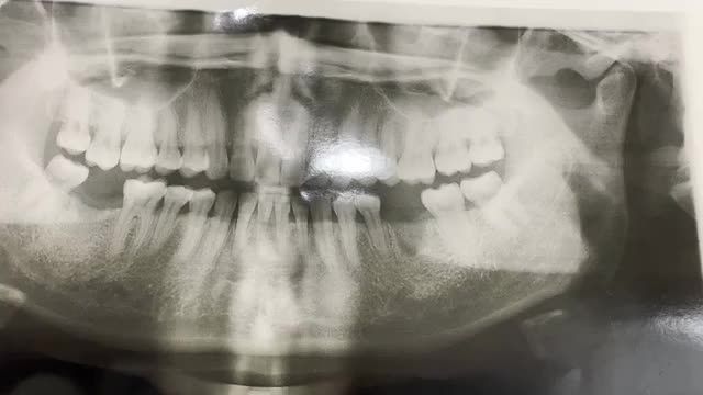 Ca cấy chân răng implant thứ 2 lên cung hàm dưới cho khách hàng tại NKTA.