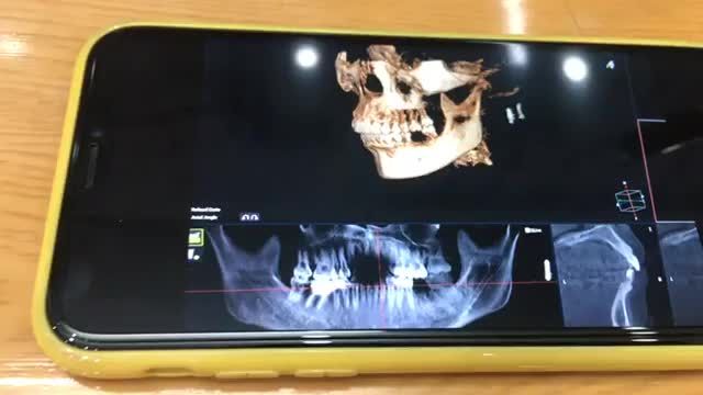 Ca cấy chân răng nhân tạo implant R36 cho bạn khách hàng tại Nha Khoa Thuỳ Anh.