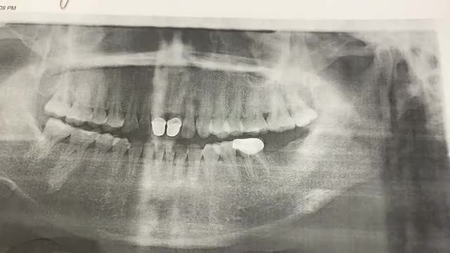 Ca cấy chân răng nhân tạo implant số 37 tại Nha Khoa Thuỳ Anh.